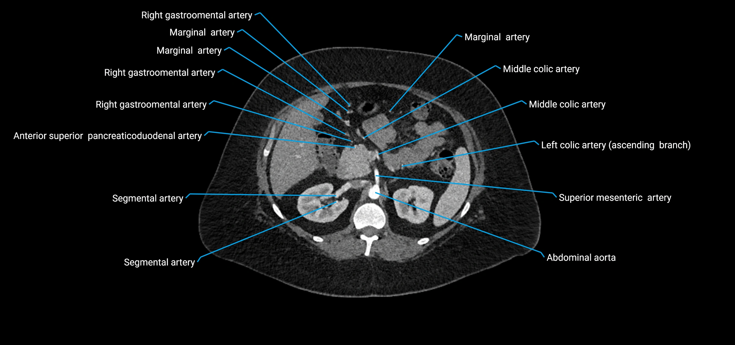 CTA abdomen axial cross sectional anatomy labelled image_65 (2).webp